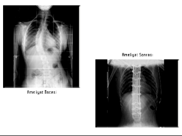 Omurga Eğriliği Olan Kız Çocuğu 5 Saatlik Ameliyatla Sağlığına Kavuştu